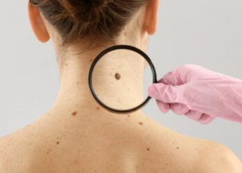 Melanoma: se diagnostican más de 1.600 casos cada año en Argentina
