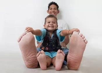 La triste historia de Jeison, el hombre con el pie más grande del mundo