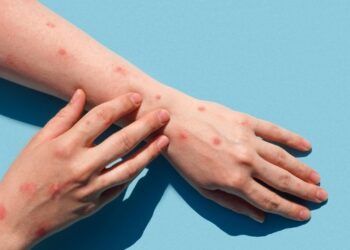 Viruela del mono: es la hora de la solidaridad